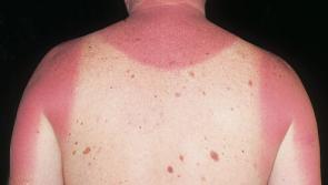 377 Tipperary people were diagnosed with skin cancer last year